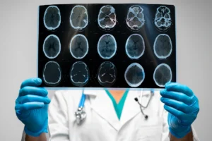 Common Brain Injuries from Car Accidents